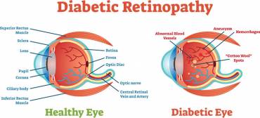 Diabetic Retinopathy