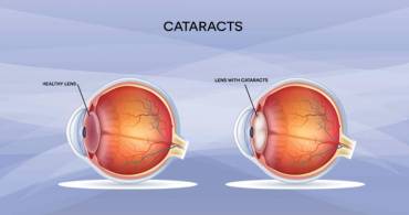 Cataracts- what exactly is it?