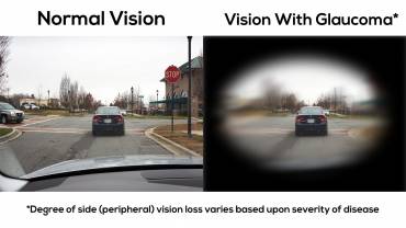 Glaucoma