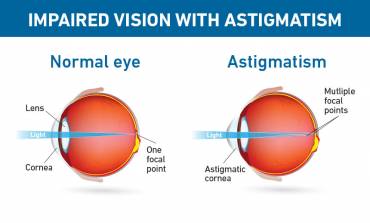 Astigmatism