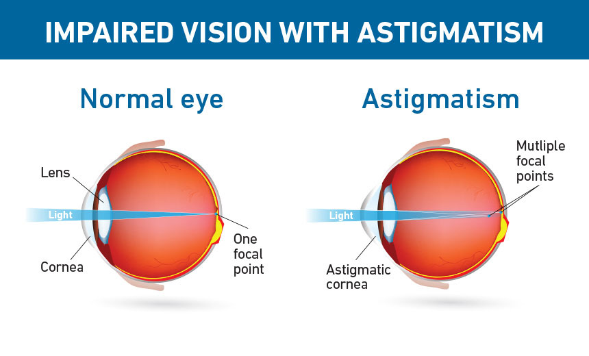 Astigmatism 